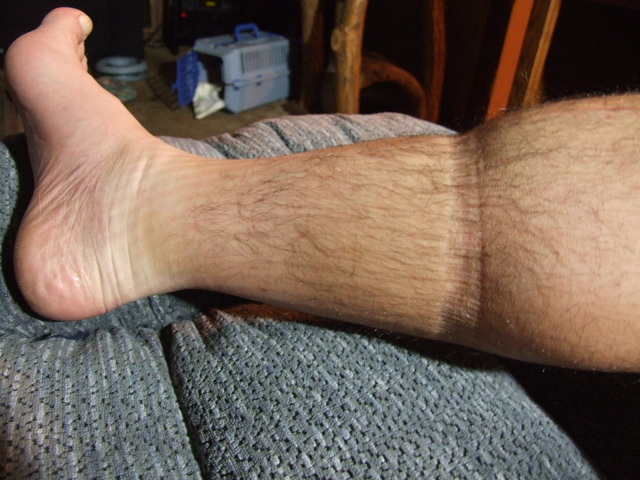Can Swollen Legs & Feet Leave Feet Bruised 116